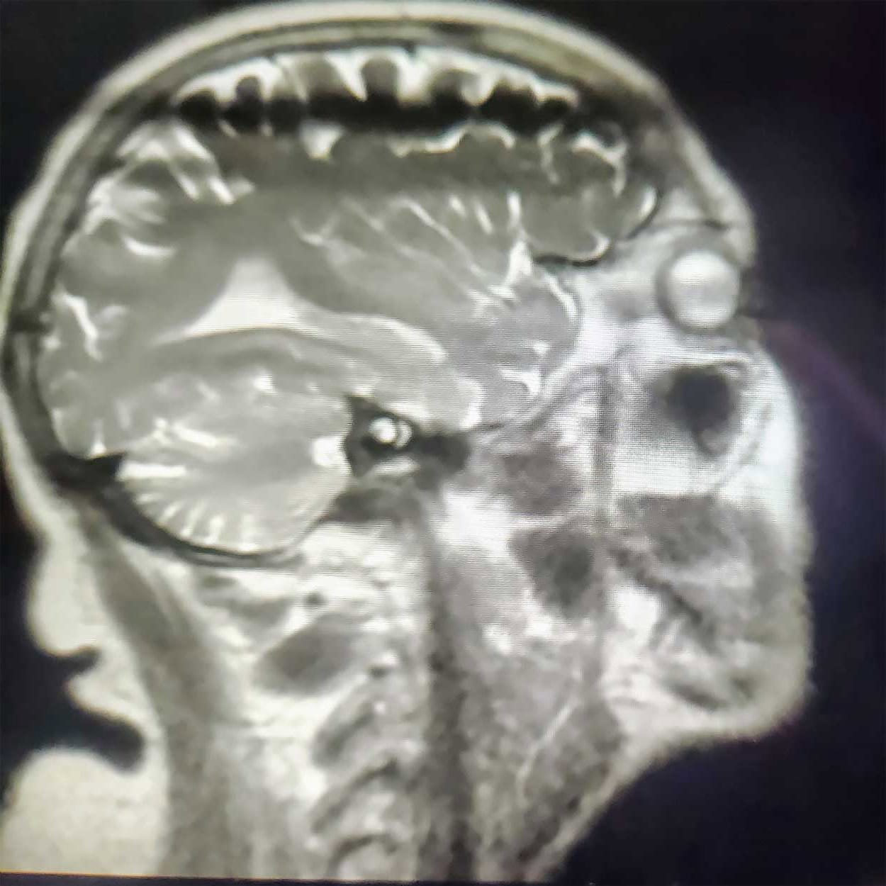 skull-xray-reversed Aphasia At Home | LAURA MALIS National Aphasia Association Ambassador