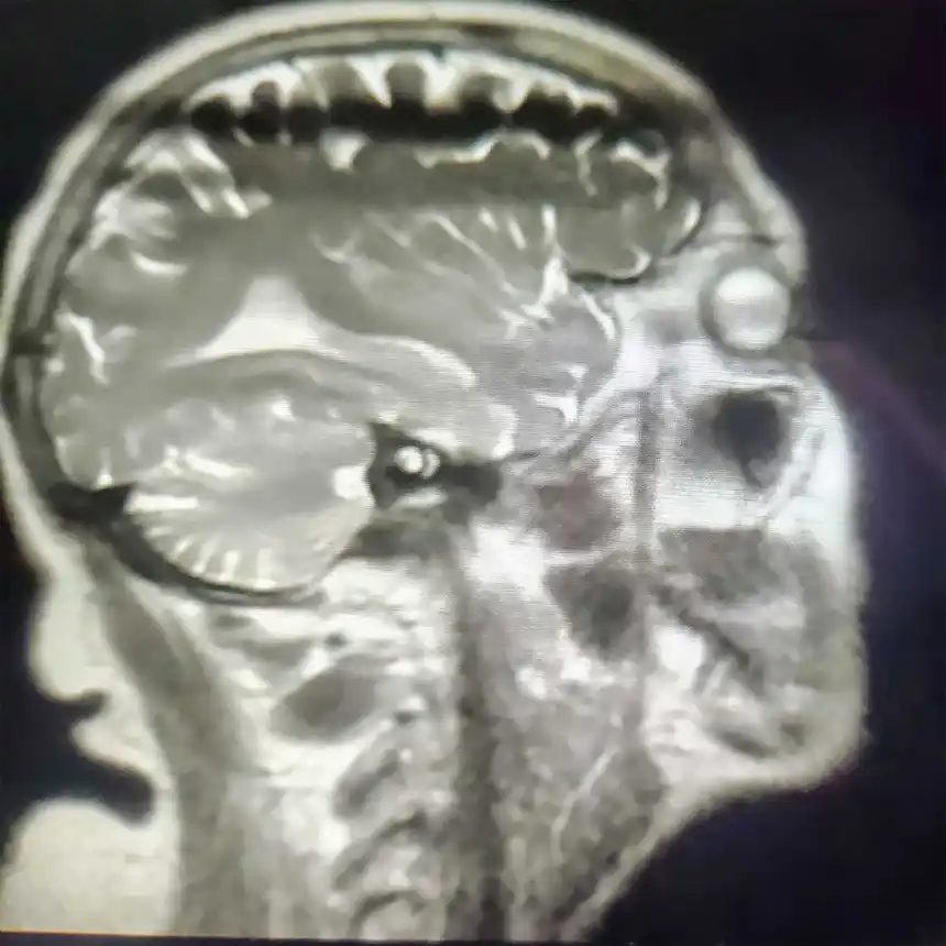 Skull X-ray